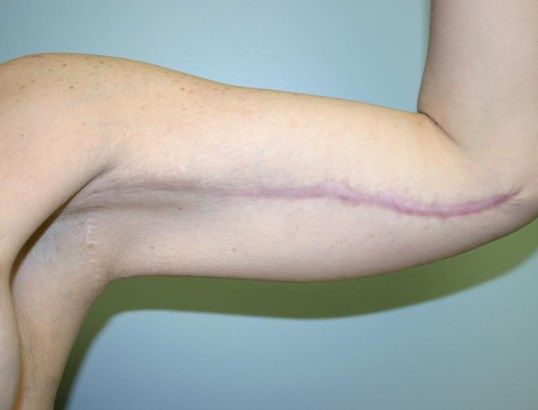 Body Contouring Before & After