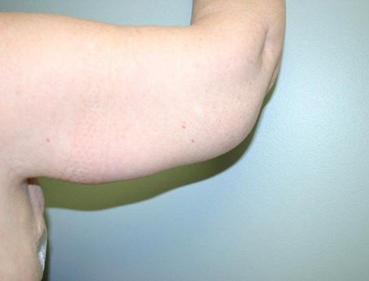 Body Contouring Before & After