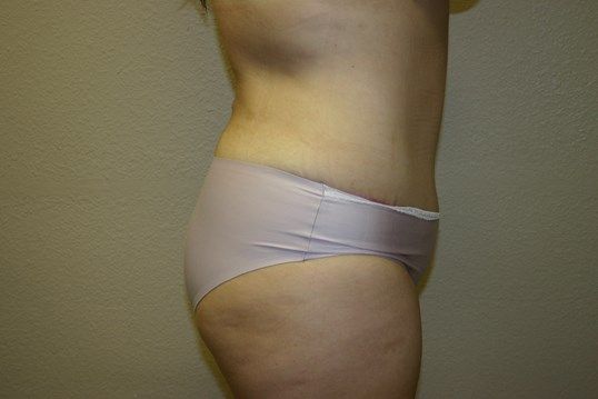 Body Contouring Before & After