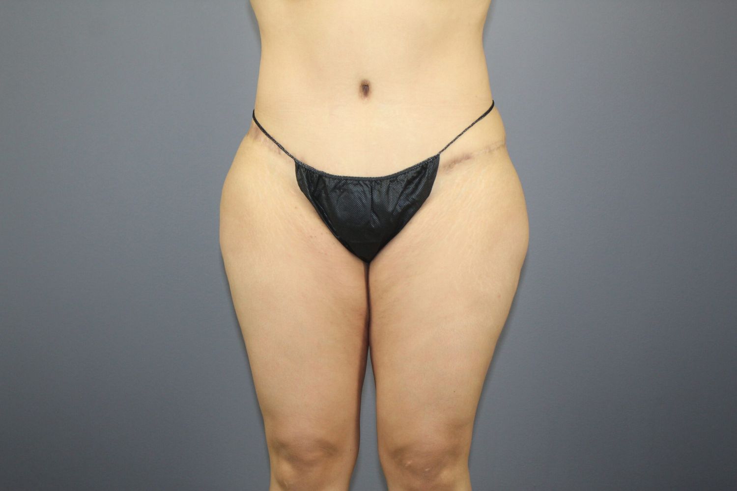 Body Contouring Before & After