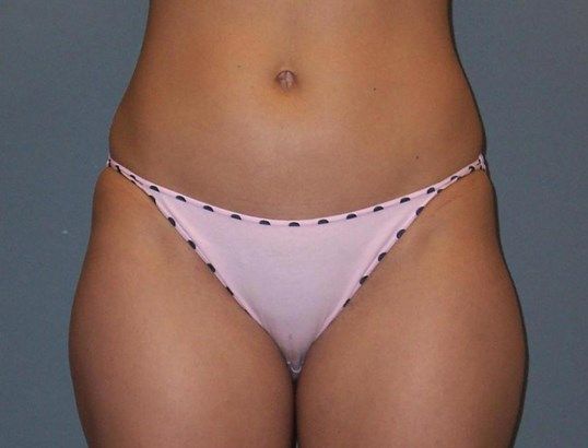 Body Contouring Before & After