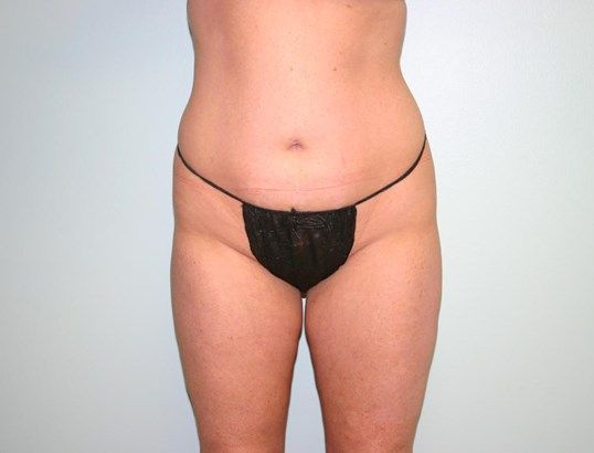 Body Contouring Before & After