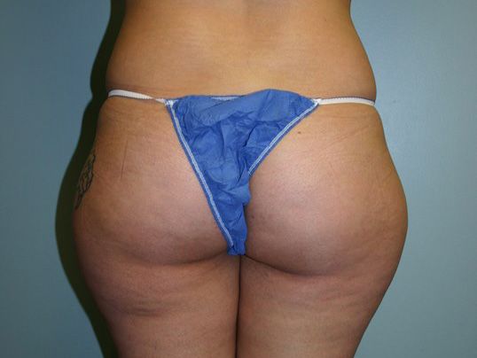 Body Contouring Before & After