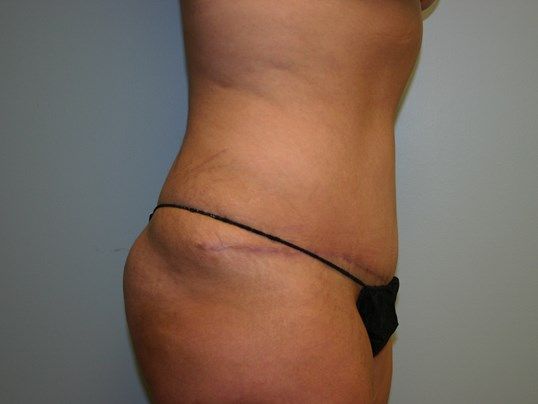 Body Contouring Before & After