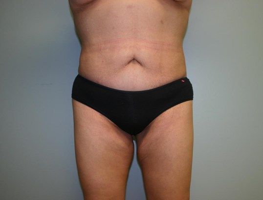 Body Contouring Before & After