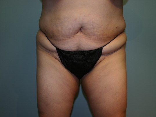 Body Contouring Before & After