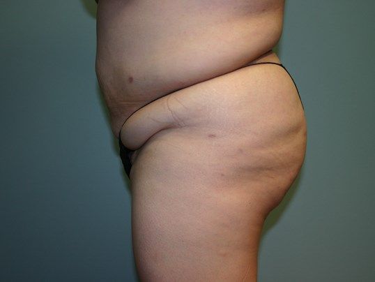 Body Contouring Before & After