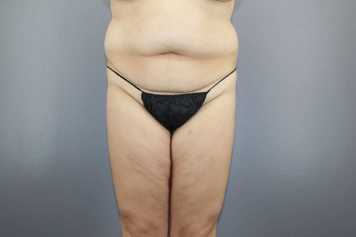 Body Contouring Before & After