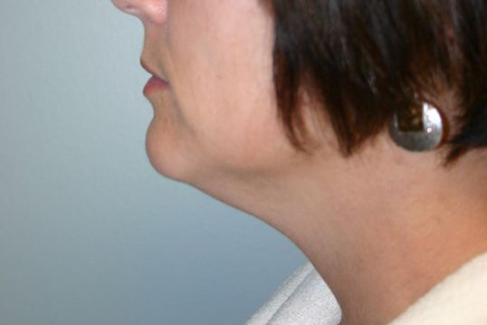 Body Contouring Before & After