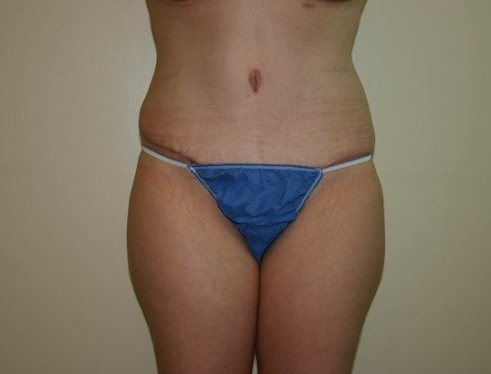 Body Contouring Before & After