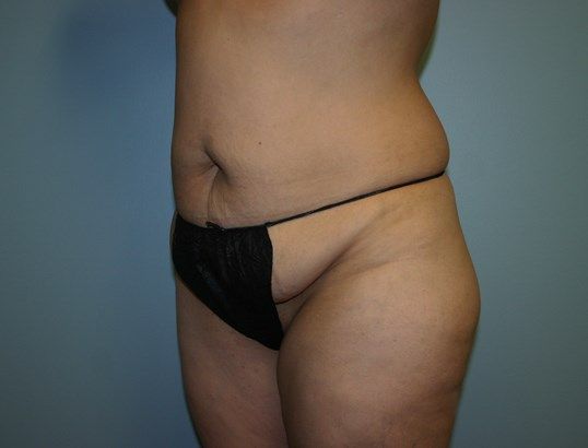 Body Contouring Before & After