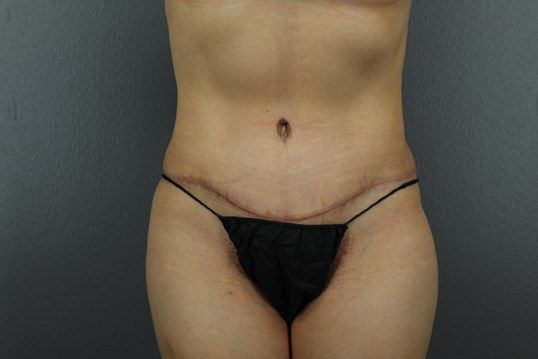 Body Contouring Before & After
