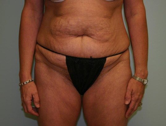 Body Contouring Before & After