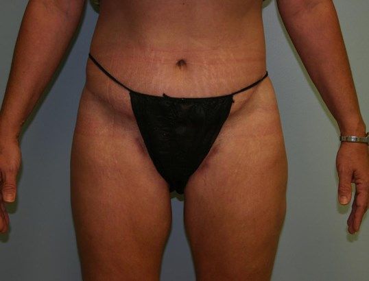 Body Contouring Before & After