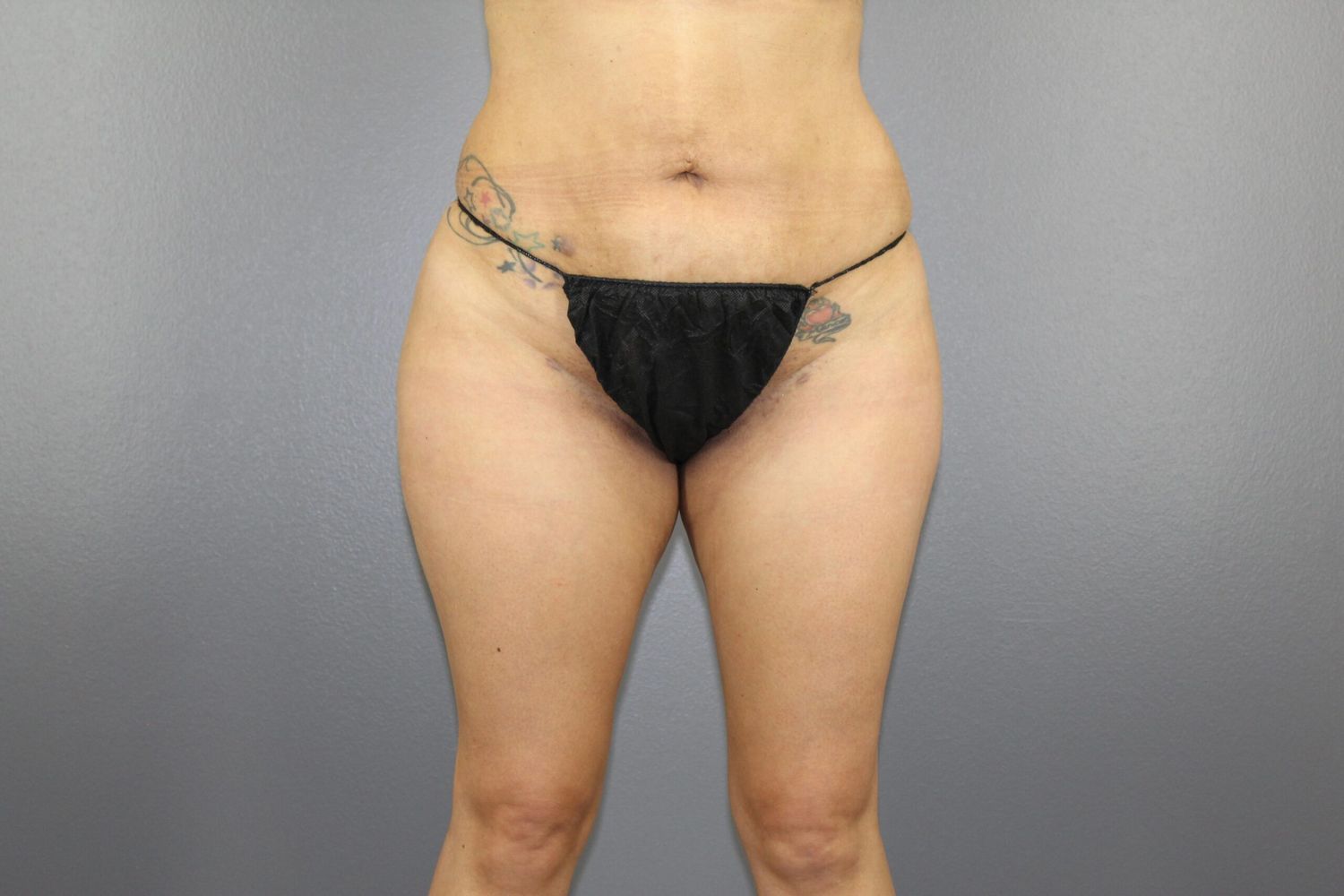Body Contouring Before & After