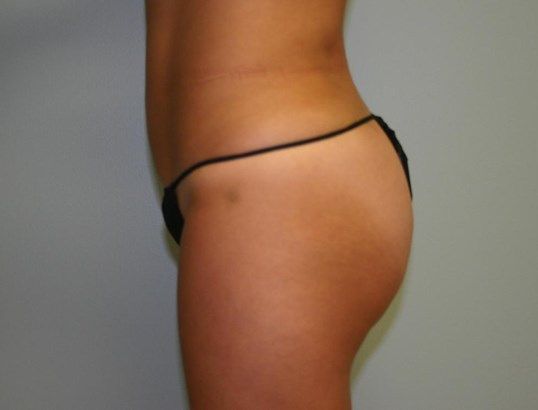 Body Contouring Before & After