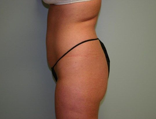 Body Contouring Before & After