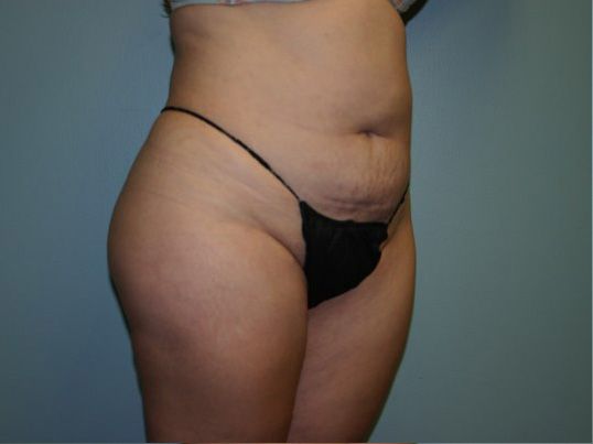 Body Contouring Before & After