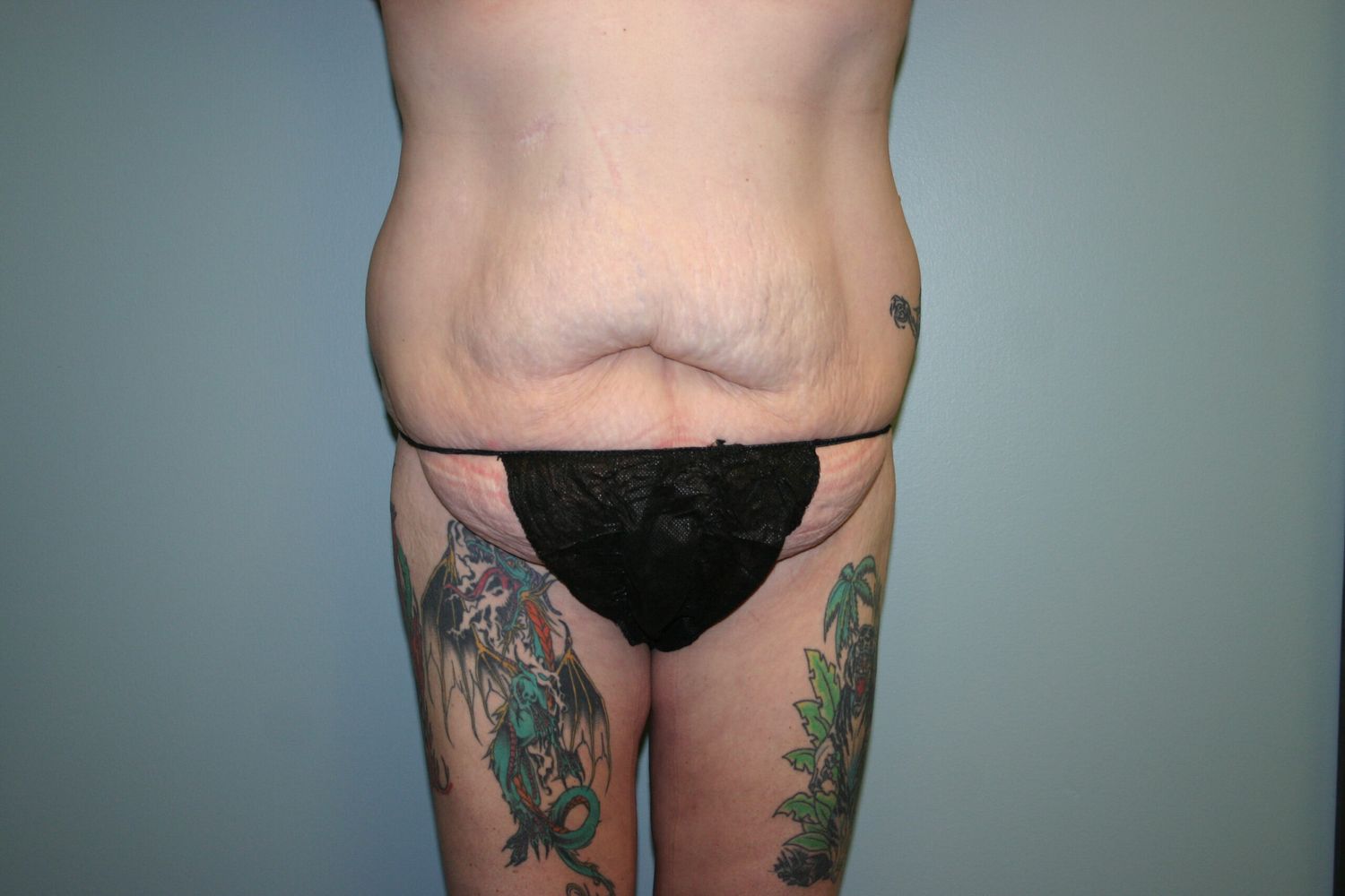 Body Contouring Before & After