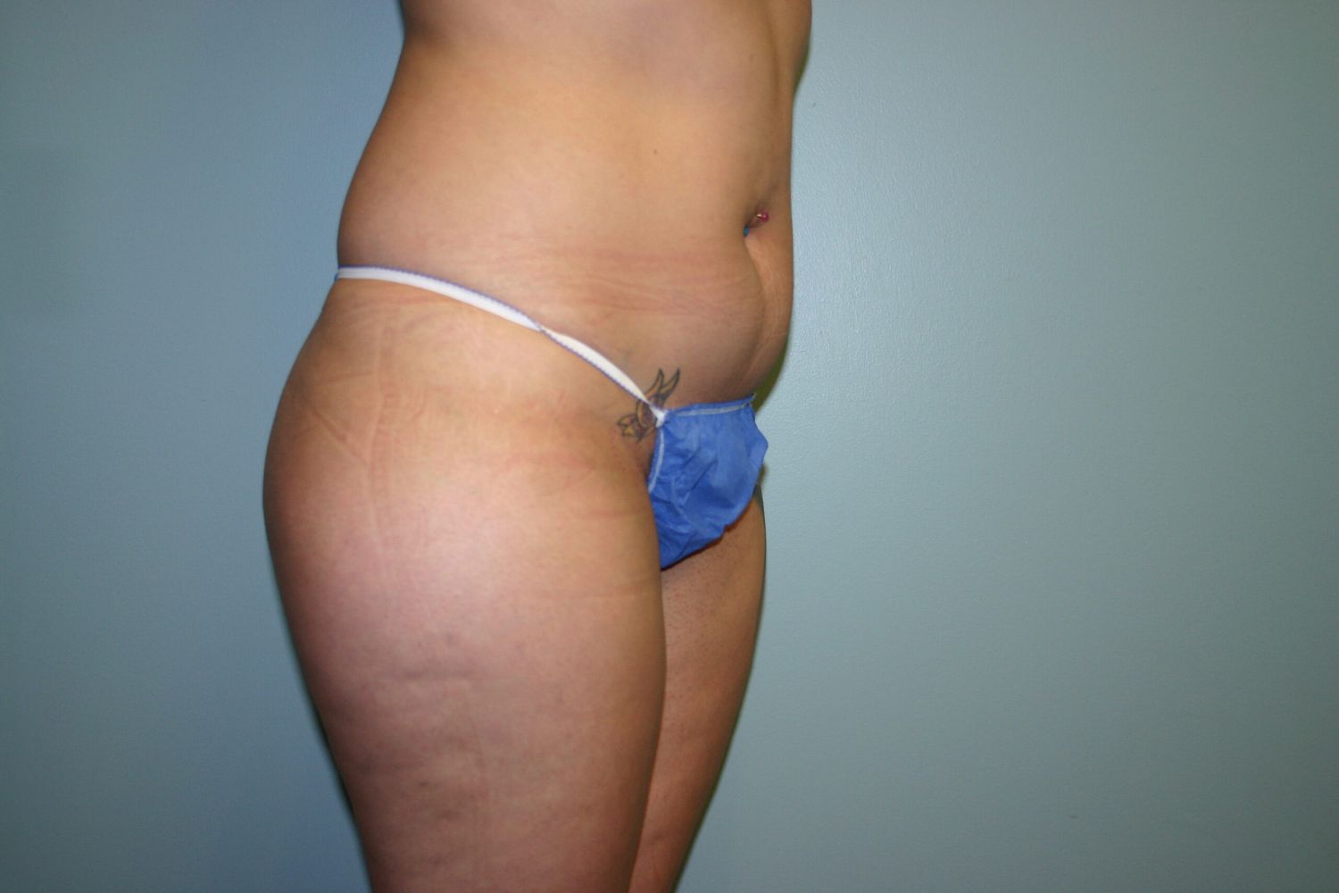 Body Contouring Before & After