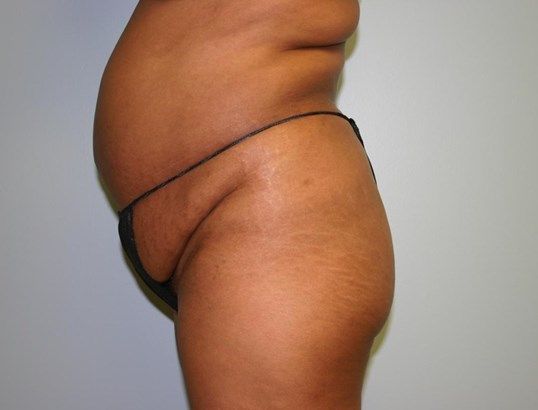 Body Contouring Before & After