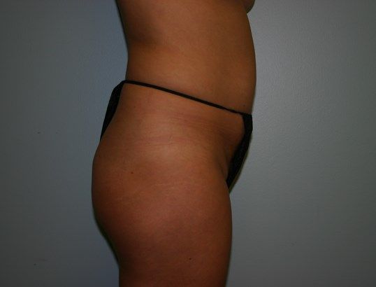 Body Contouring Before & After