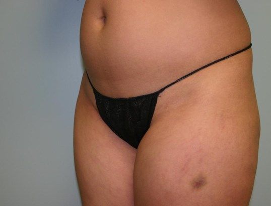 Body Contouring Before & After