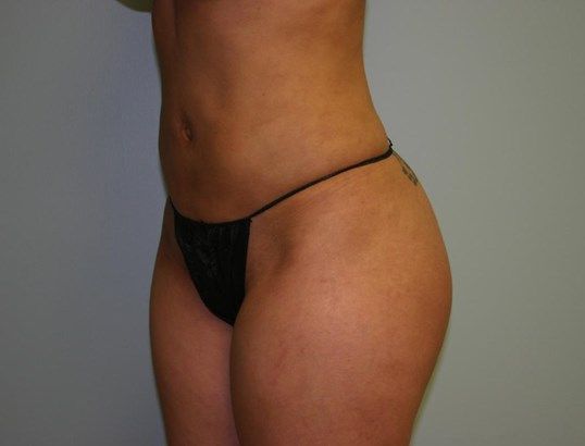 Body Contouring Before & After
