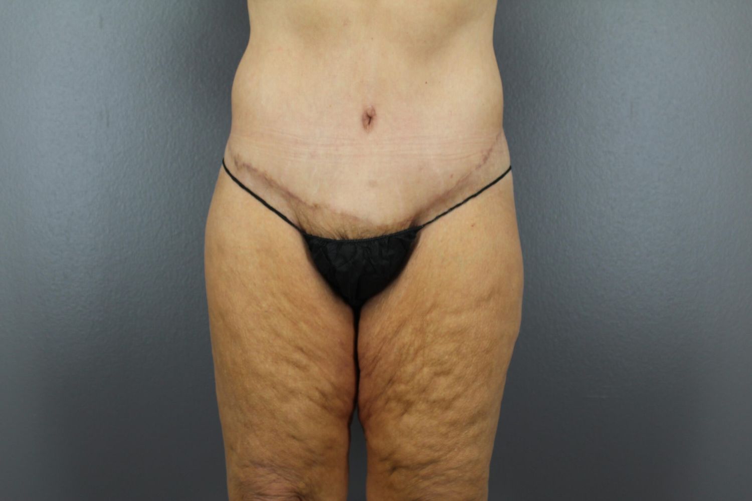 Body Contouring Before & After