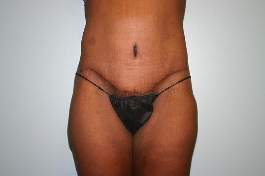 Body Contouring Before & After