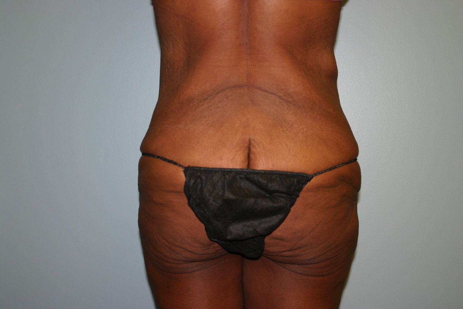 Body Contouring Before & After