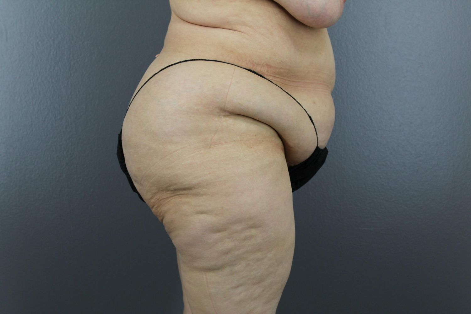 Body Contouring Before & After