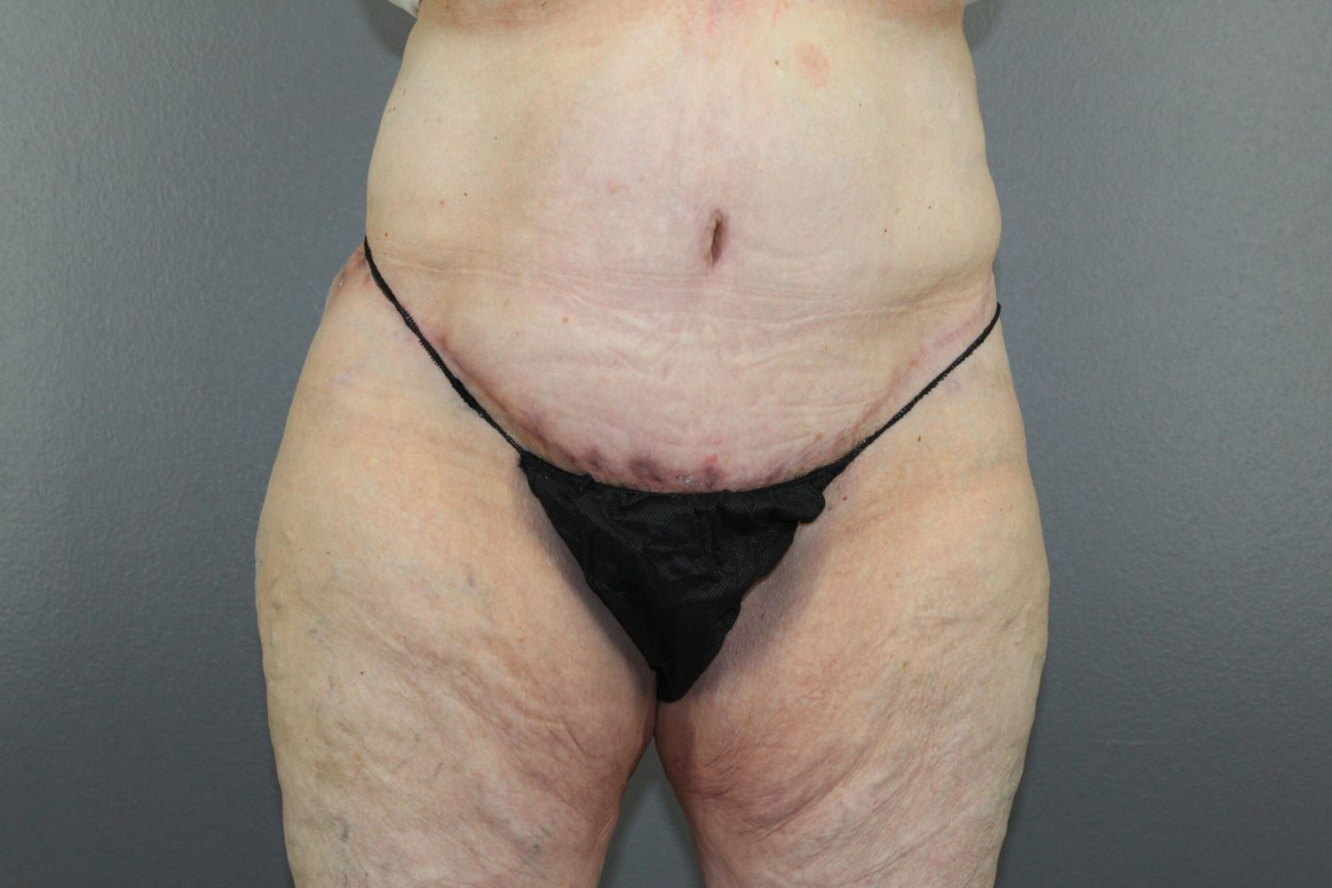 Body Contouring Before & After