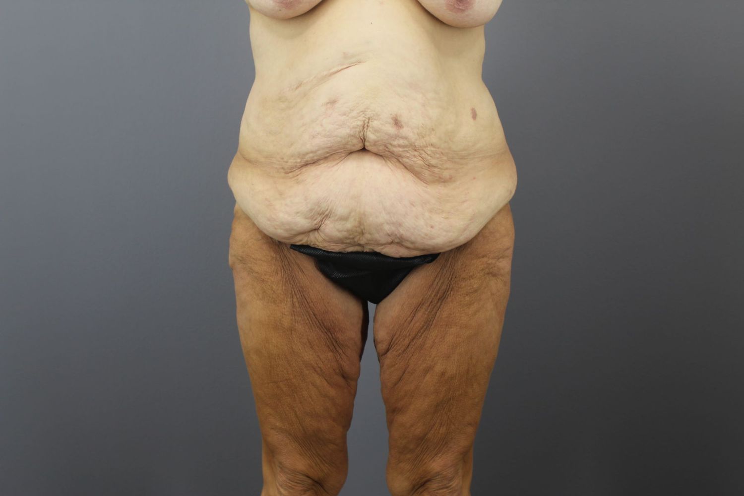 Body Contouring Before & After