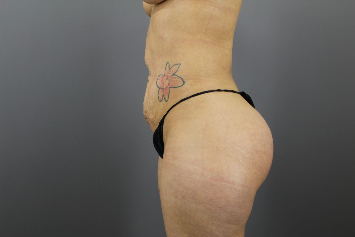Body Contouring Before & After