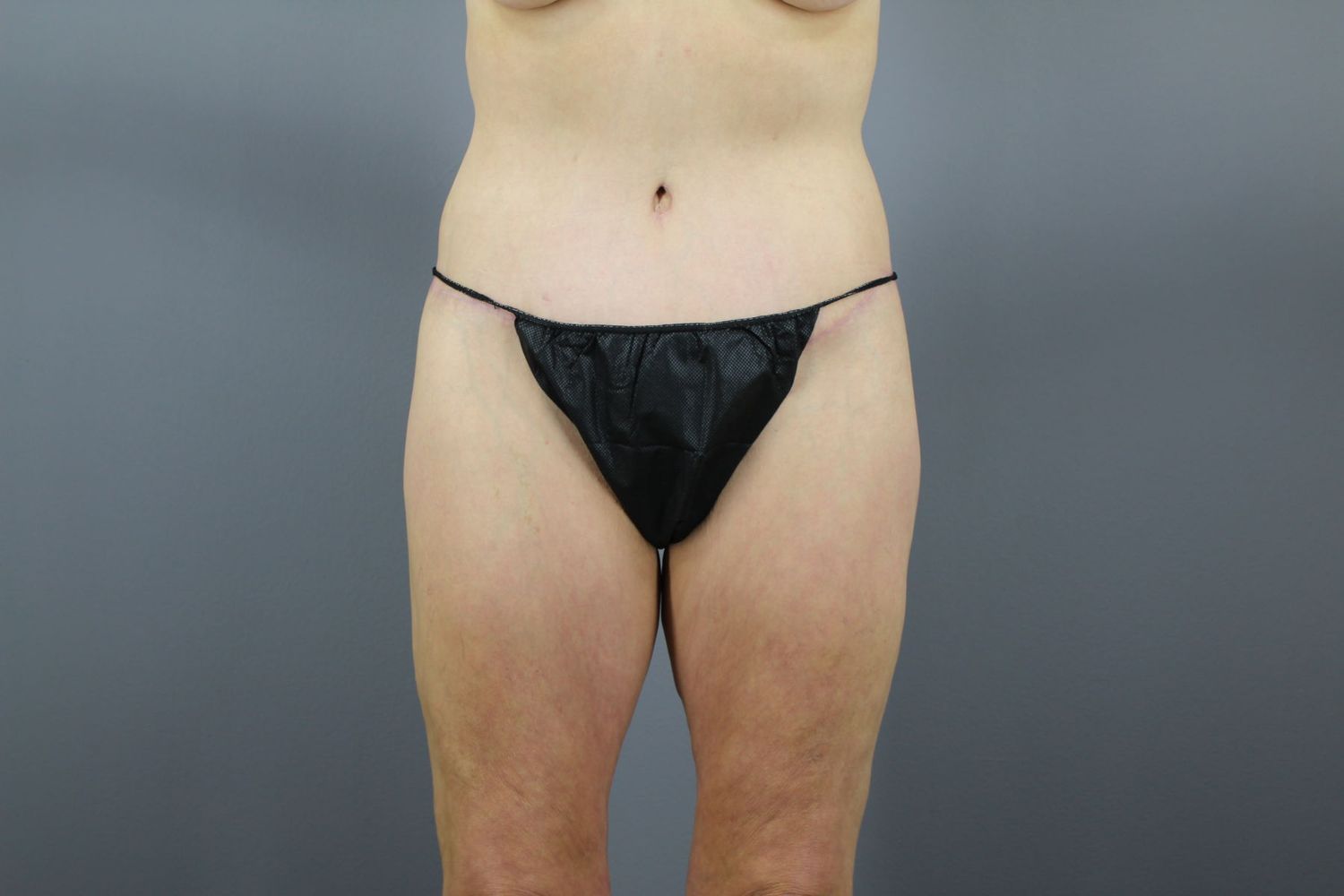 Body Contouring Before & After