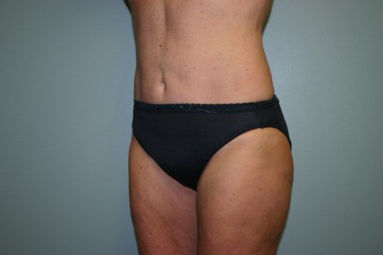 Body Contouring Before & After