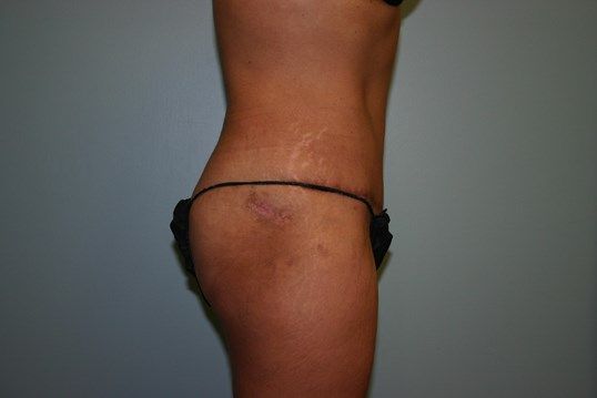 Body Contouring Before & After