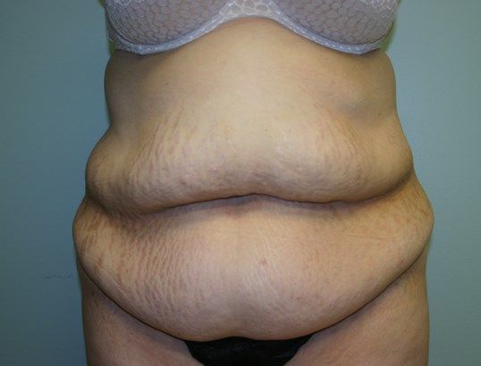 Body Contouring Before & After