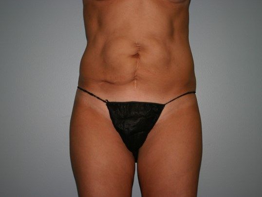 Body Contouring Before & After