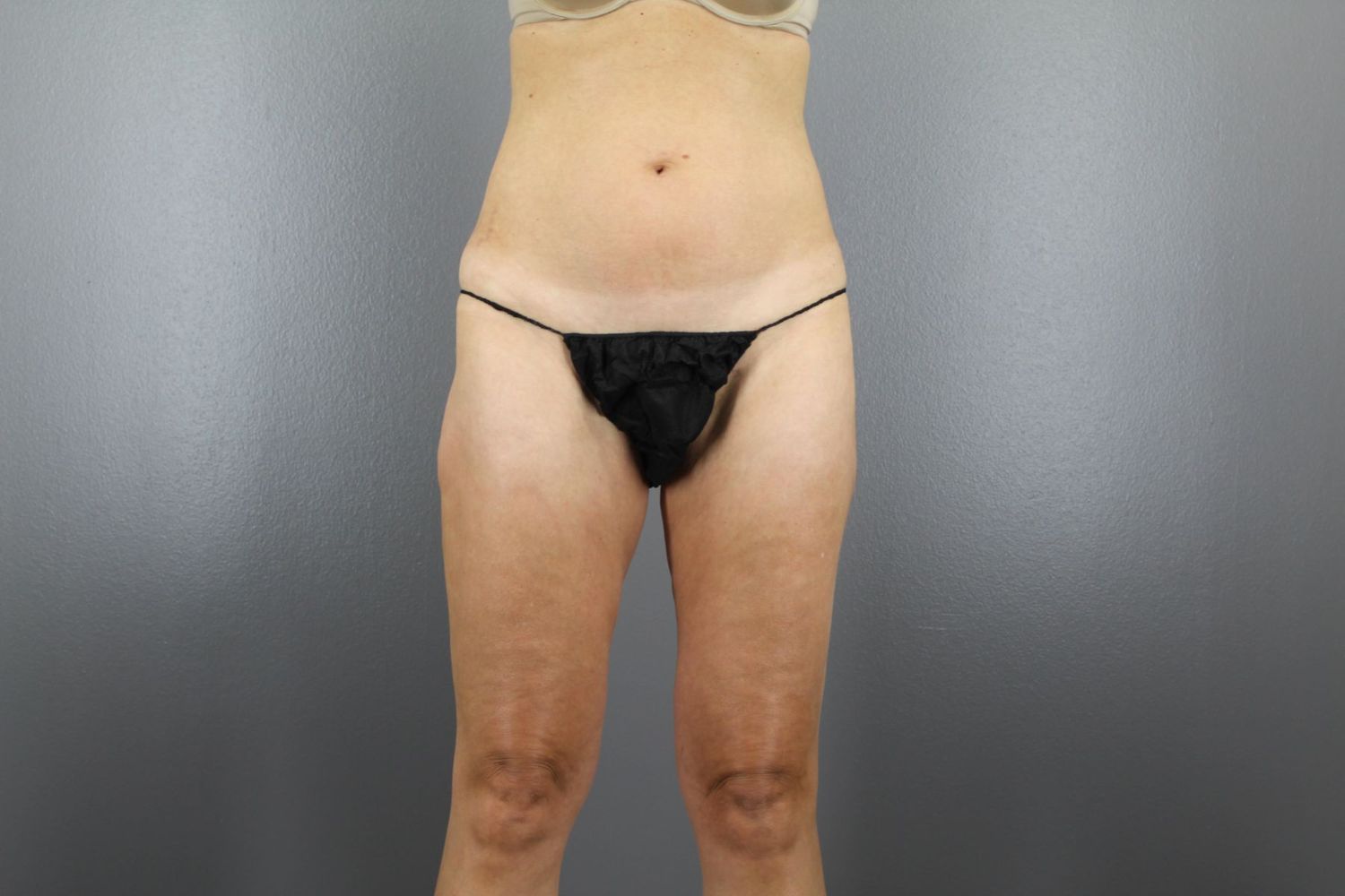 Body Contouring Before & After