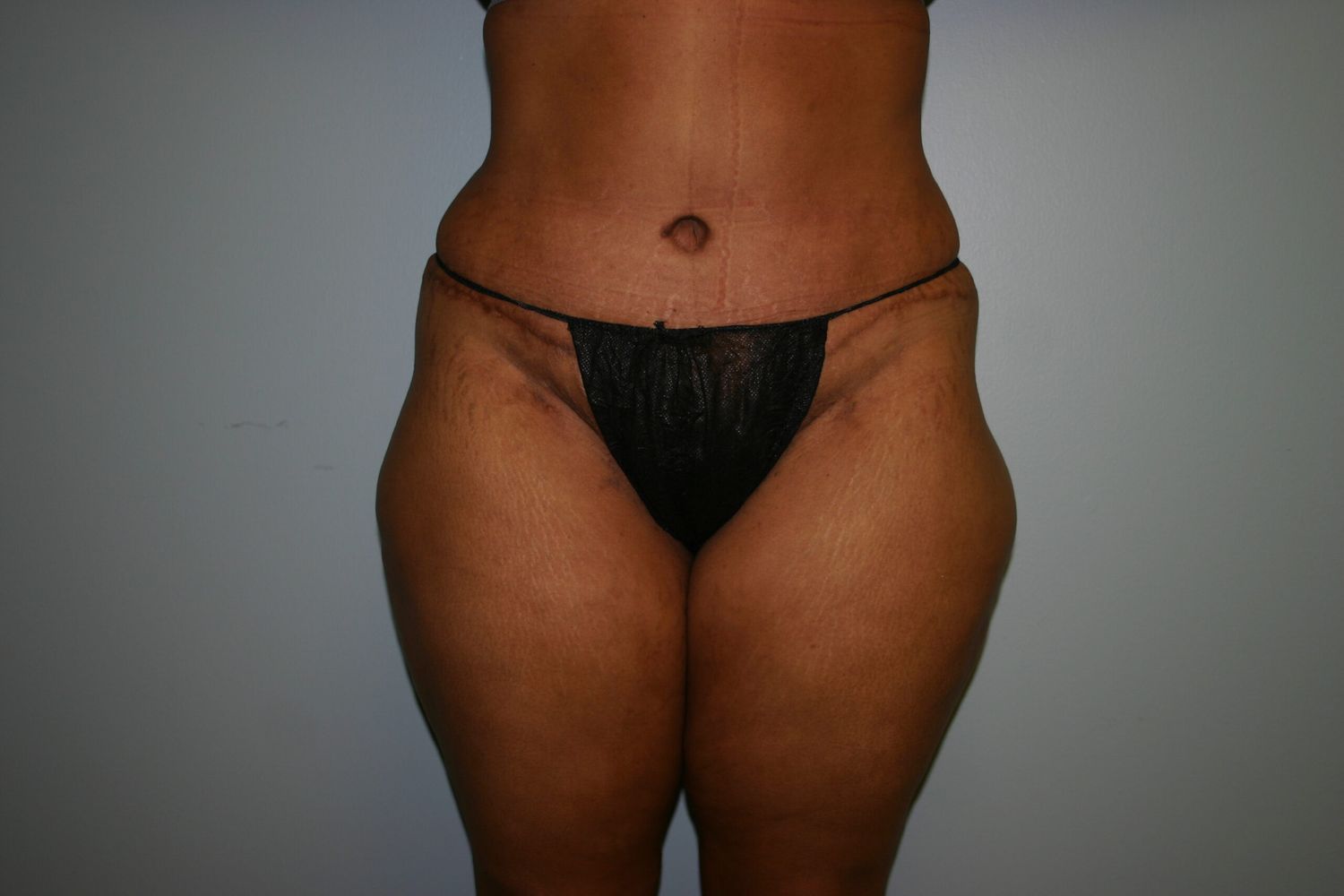Body Contouring Before & After