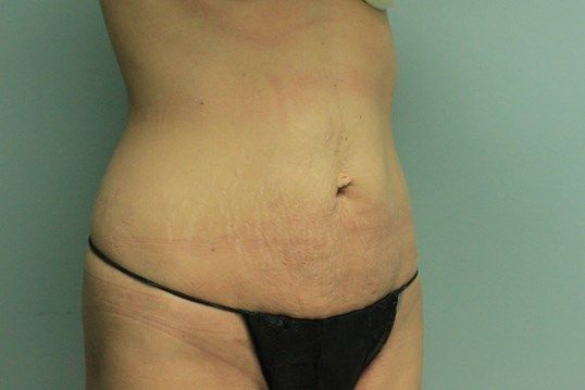 Body Contouring Before & After