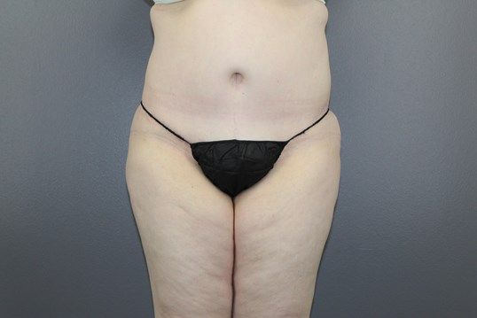 Body Contouring Before & After