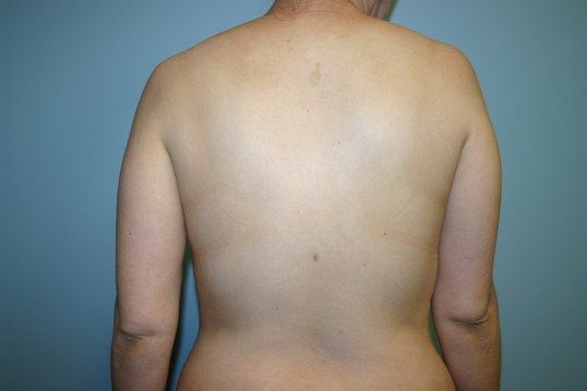 Body Contouring Before & After