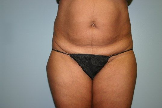 Body Contouring Before & After