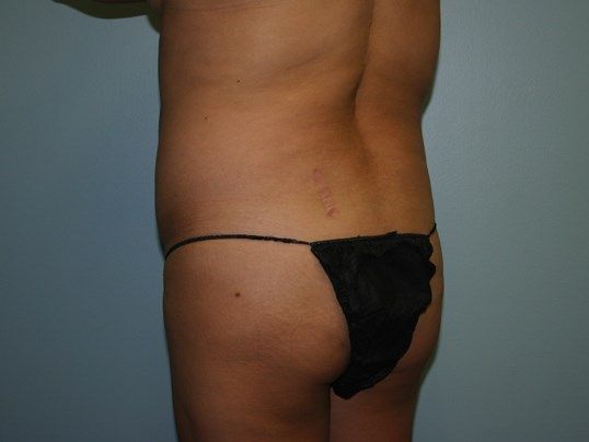 Body Contouring Before & After