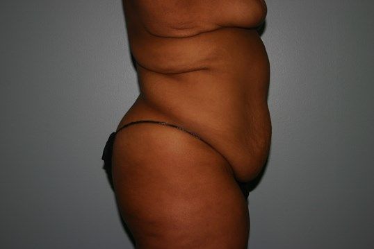 Body Contouring Before & After