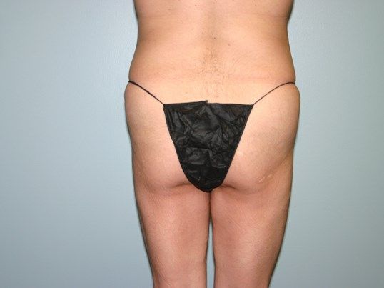 Body Contouring Before & After