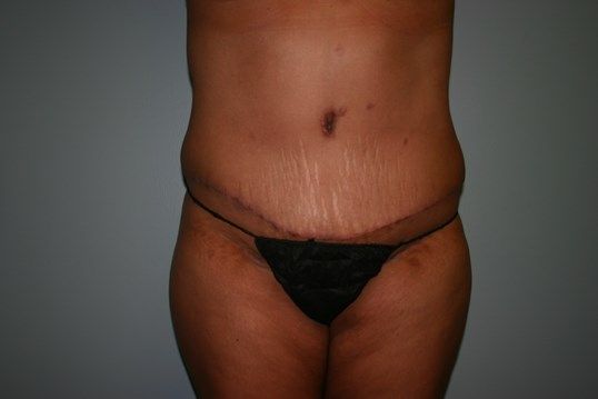 Body Contouring Before & After